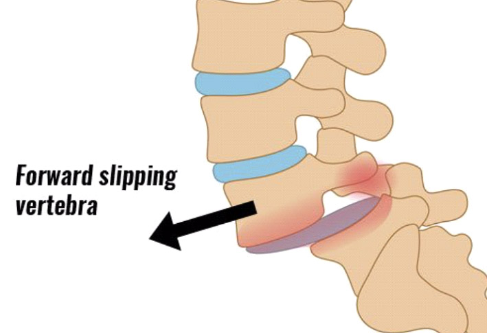 Spondylolisthesis