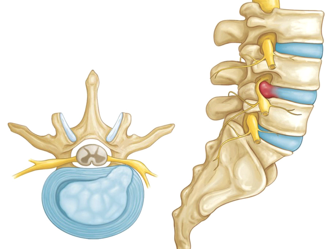 Disc Herniation/Protrusions