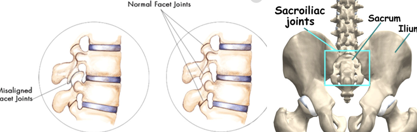 Mechanical Back and Neck Pain