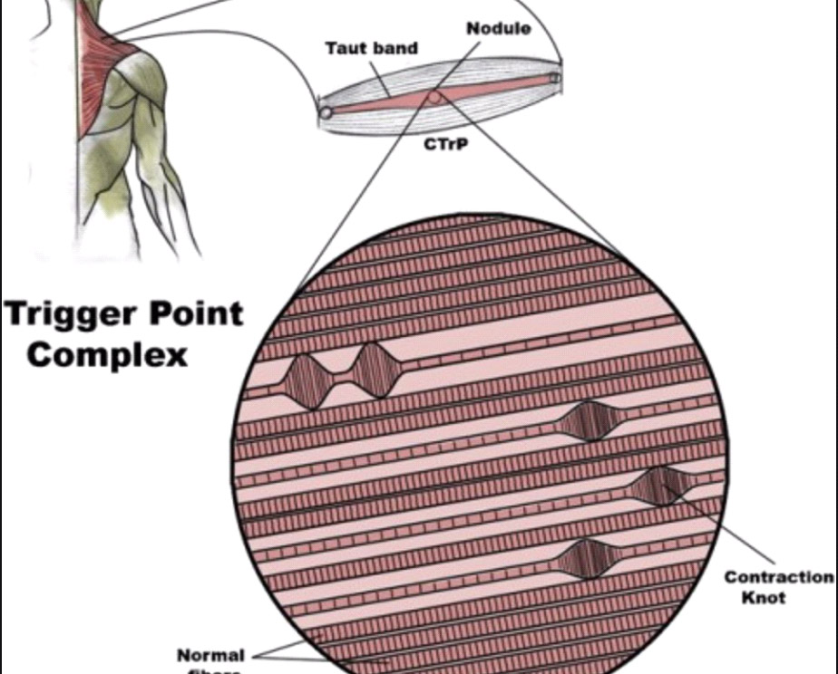 myofascial