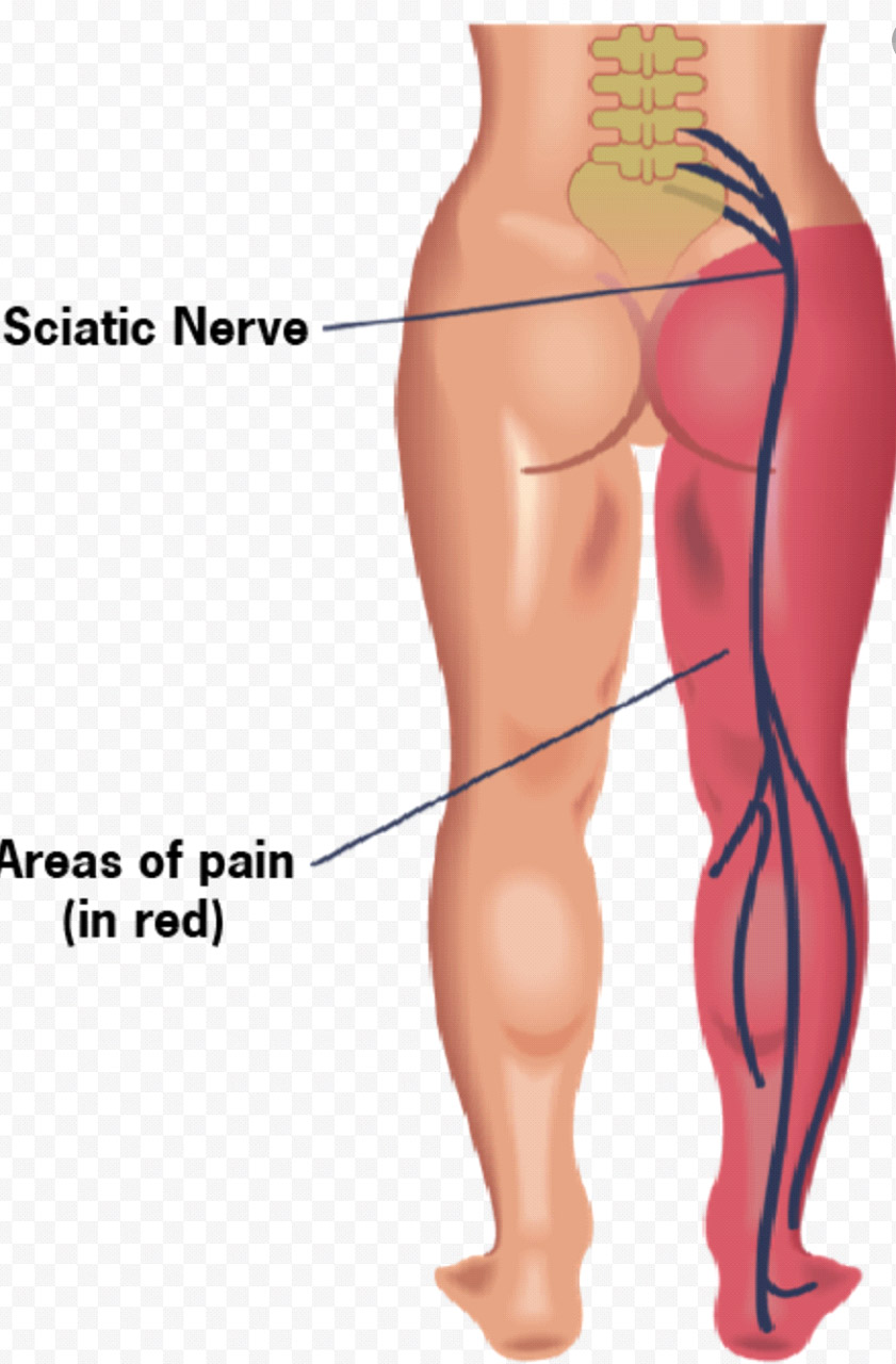 sciatica