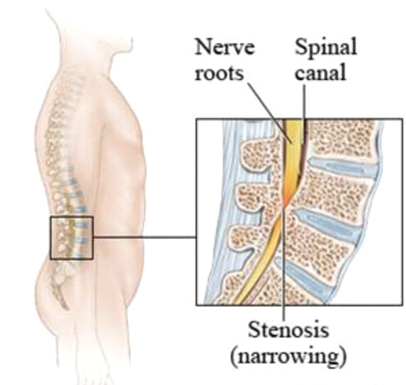 Spinal Stenosis