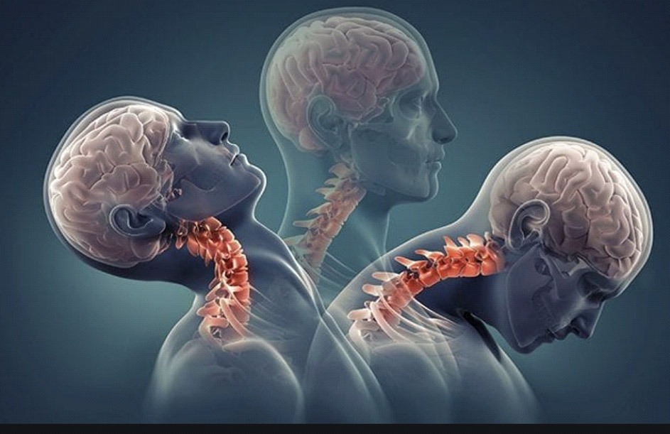 Whiplash Injury